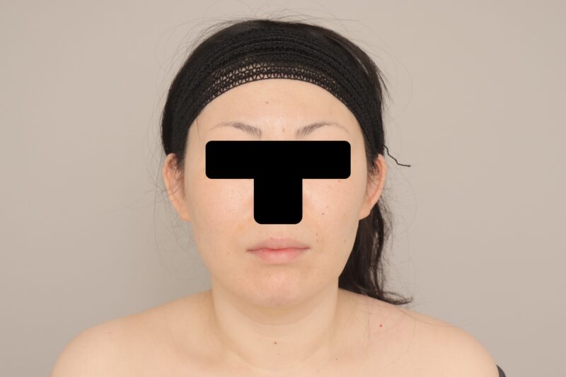 ベイザー脂肪吸引（２週間経過：38）の術後写真