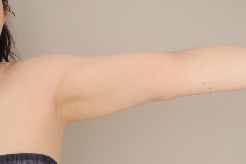 ベイザー脂肪吸引(2か月経過:38)の術後写真