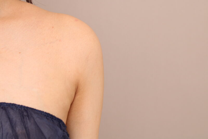 腕が筋肉質の方の脂肪吸引も綺麗に仕上げます！