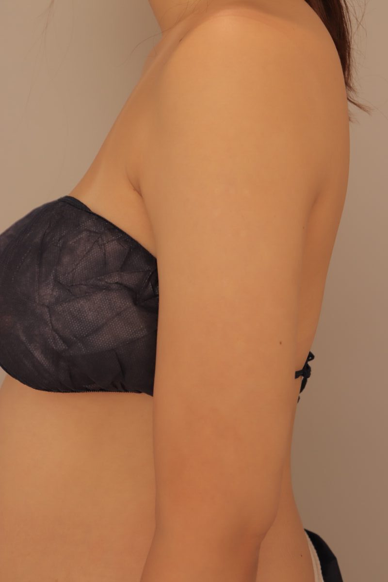 ★脇肉脂肪吸引のメリット