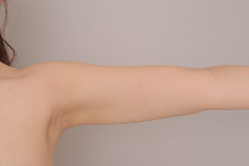 脂肪豊胸と同時に二の腕・肩・脇肉も徹底吸引！3ヶ月で見た目激変＆“巨乳映え”確定