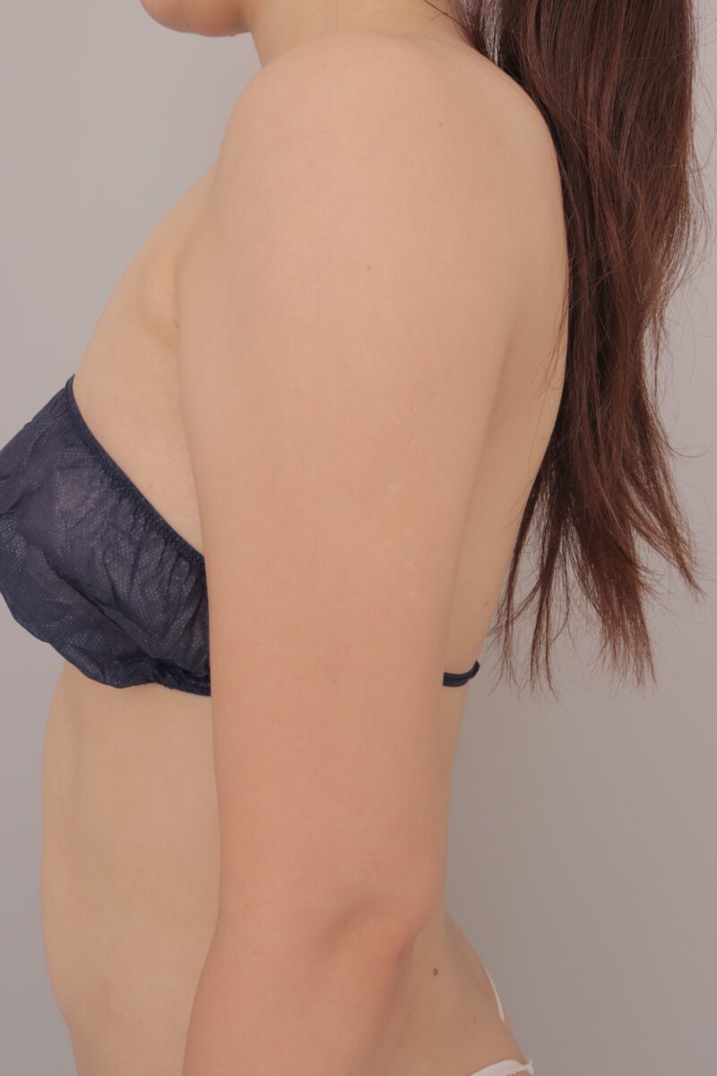 ベイザー脂肪吸引(3ヶ月経過:31)の術後写真