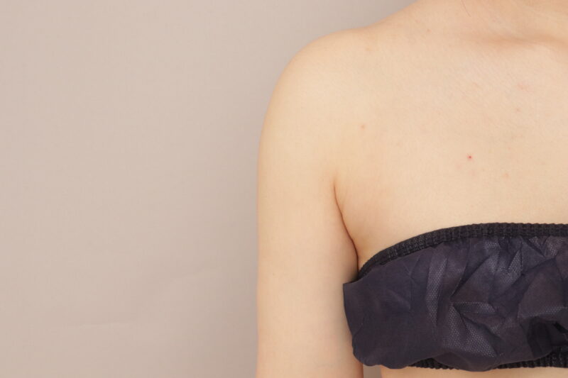 二の腕の脂肪吸引は、もともと細い方でもおすすめなんです。