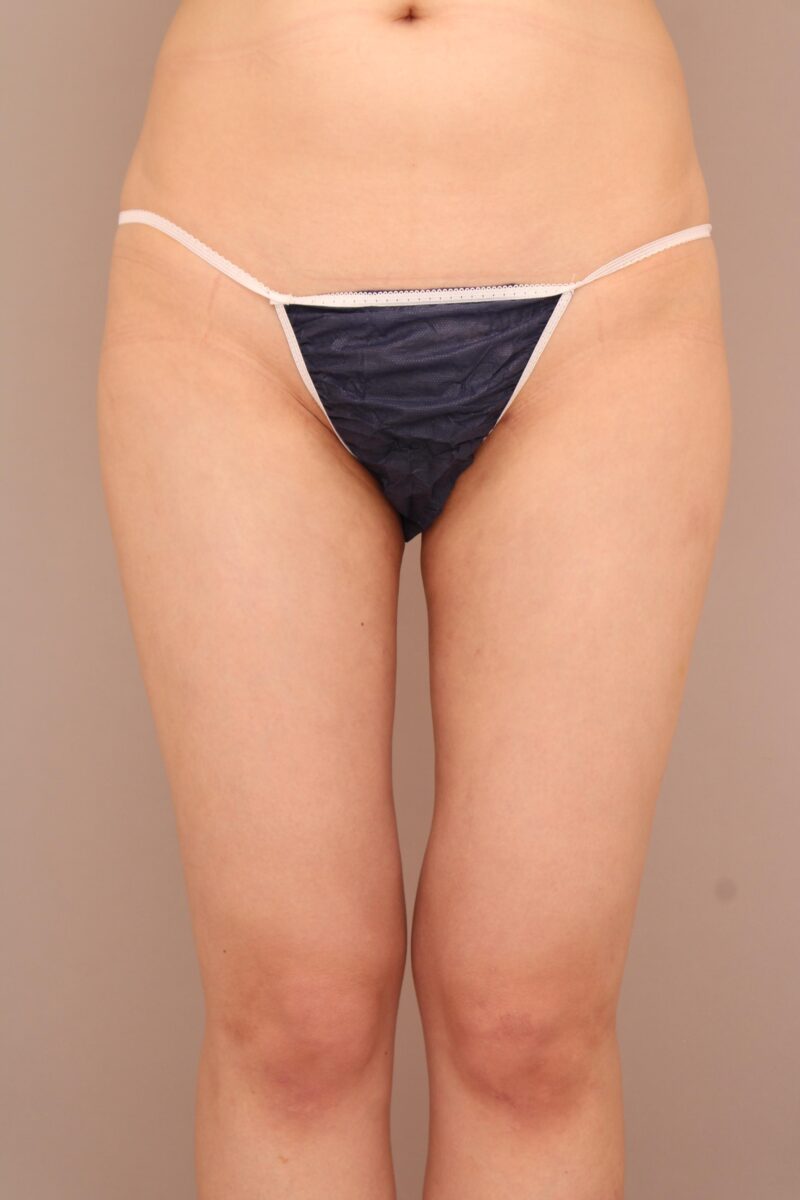 内ももの隙間を作り外張りも改善、太ももをすっきりとした印象に！