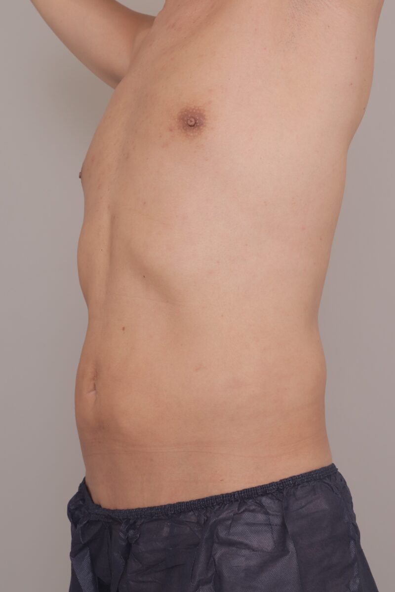 3ヶ月でここまで変化！腹部＋胸下＋腰2300cc吸引で“浮き輪肉ゼロ＆自然な腹筋ライン”へ