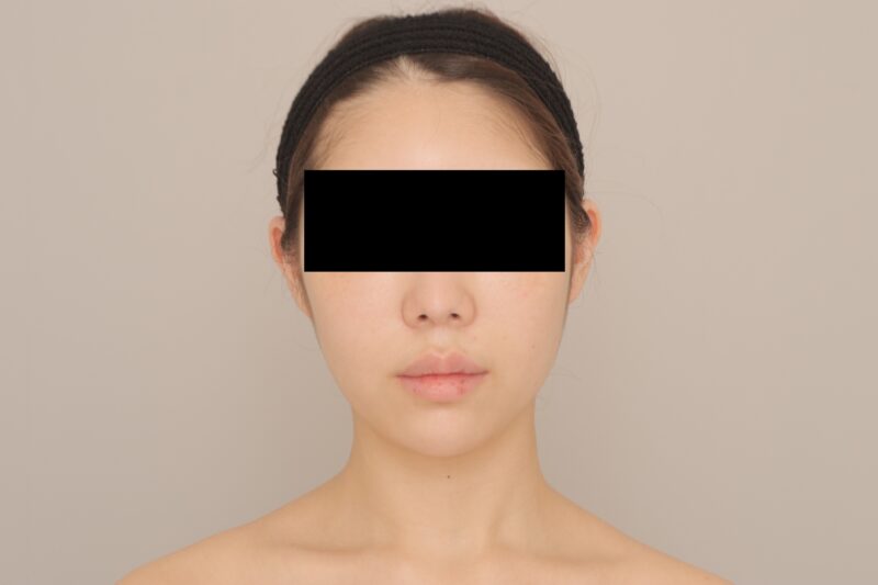 ベイザー脂肪吸引（3ヵ月経過：24）の術前写真