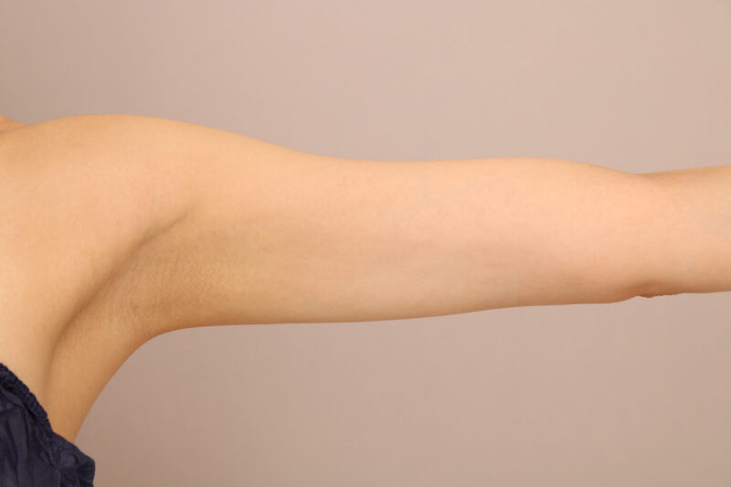 もともと華奢な腕もより理想のシルエットに！