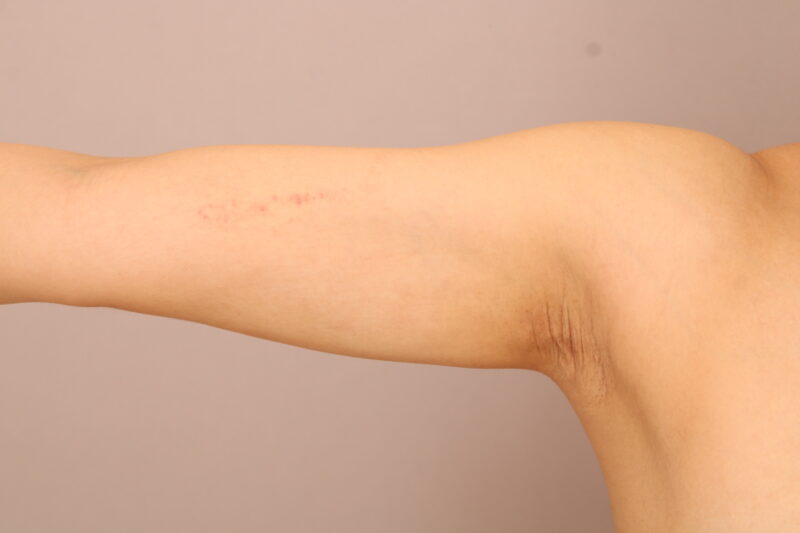 脂肪吸引で肩からストンと落ちるような華奢な腕のシルエットに！