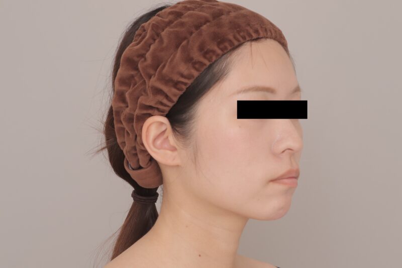 小顔施術の王道、頬顎下脂肪吸引