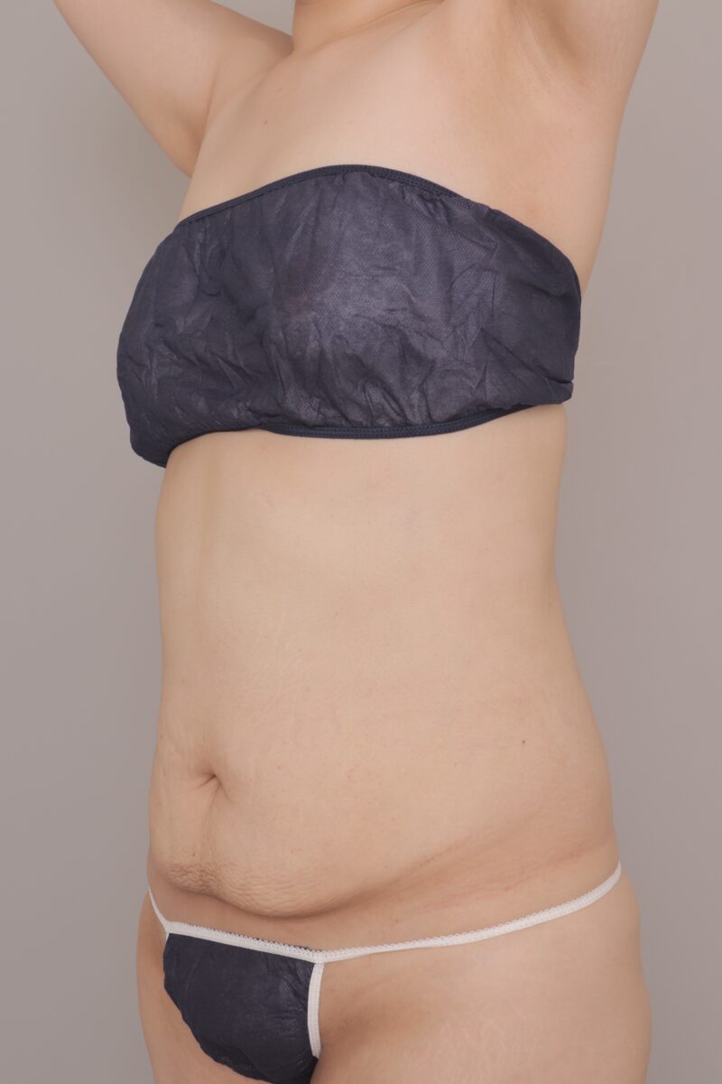 激痩せ後に残った“たるみ腹”を改善。2500cc吸引でスッキリとしたシルエットへ
