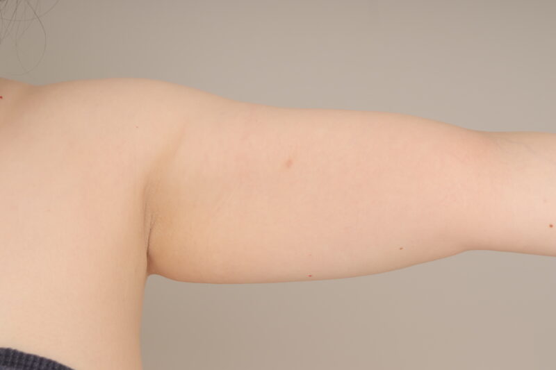 ベイザー脂肪吸引(2か月経過:38)の術前写真