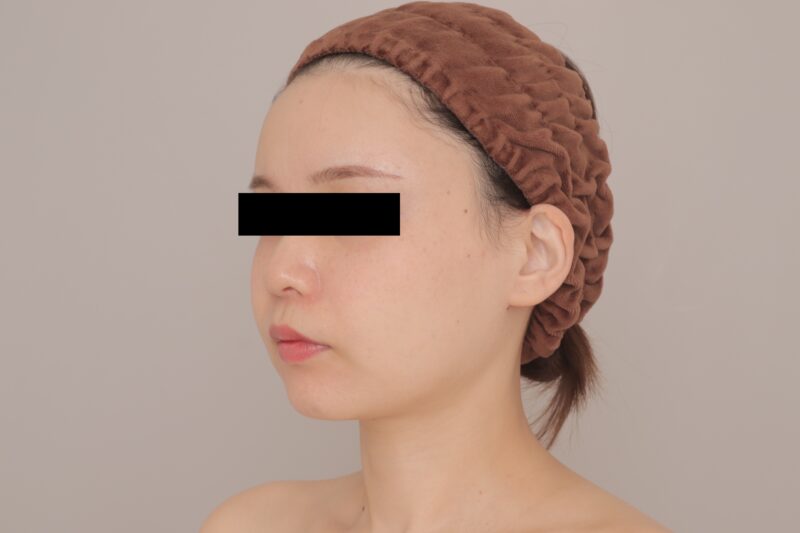 ベイザー脂肪吸引(1ヶ月経過:29)の術後写真