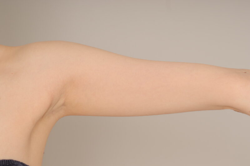 ベイザー脂肪吸引（１ヶ月経過：31）の術前写真