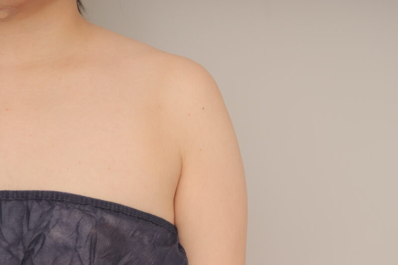 ベイザー脂肪吸引(1ヶ月経過:25)の術前写真