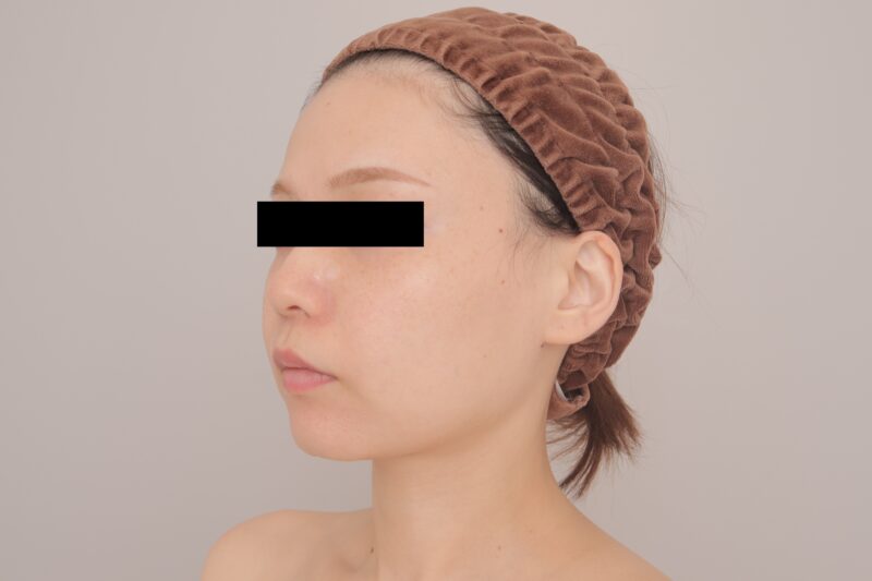 ベイザー脂肪吸引(1ヶ月経過:29)の術前写真