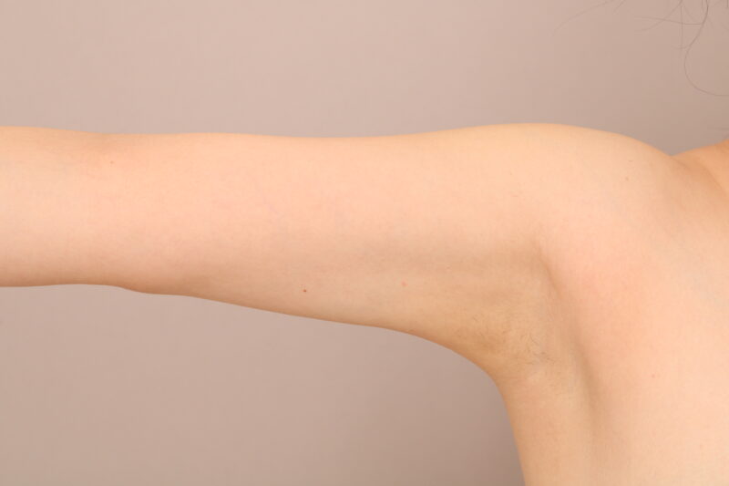 元々細い腕の方もさらに細く理想のシルエットへ！