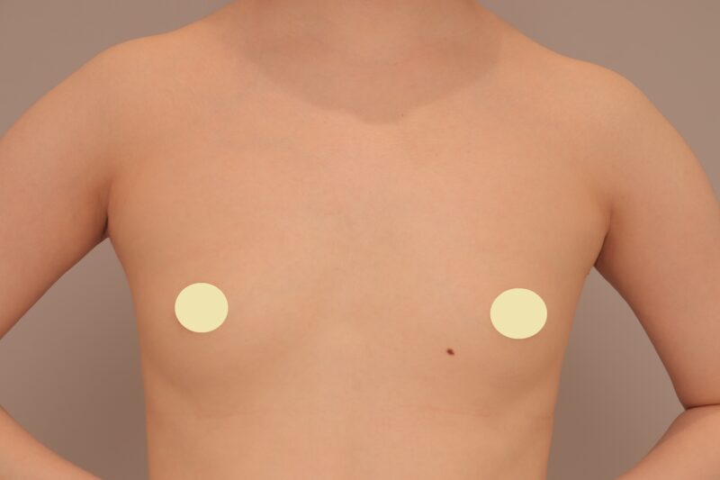 ベイザー脂肪吸引（１ヶ月経過：21）の術前写真