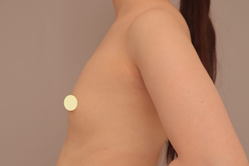 ベイザー脂肪吸引（１ヶ月経過：21）の術前写真