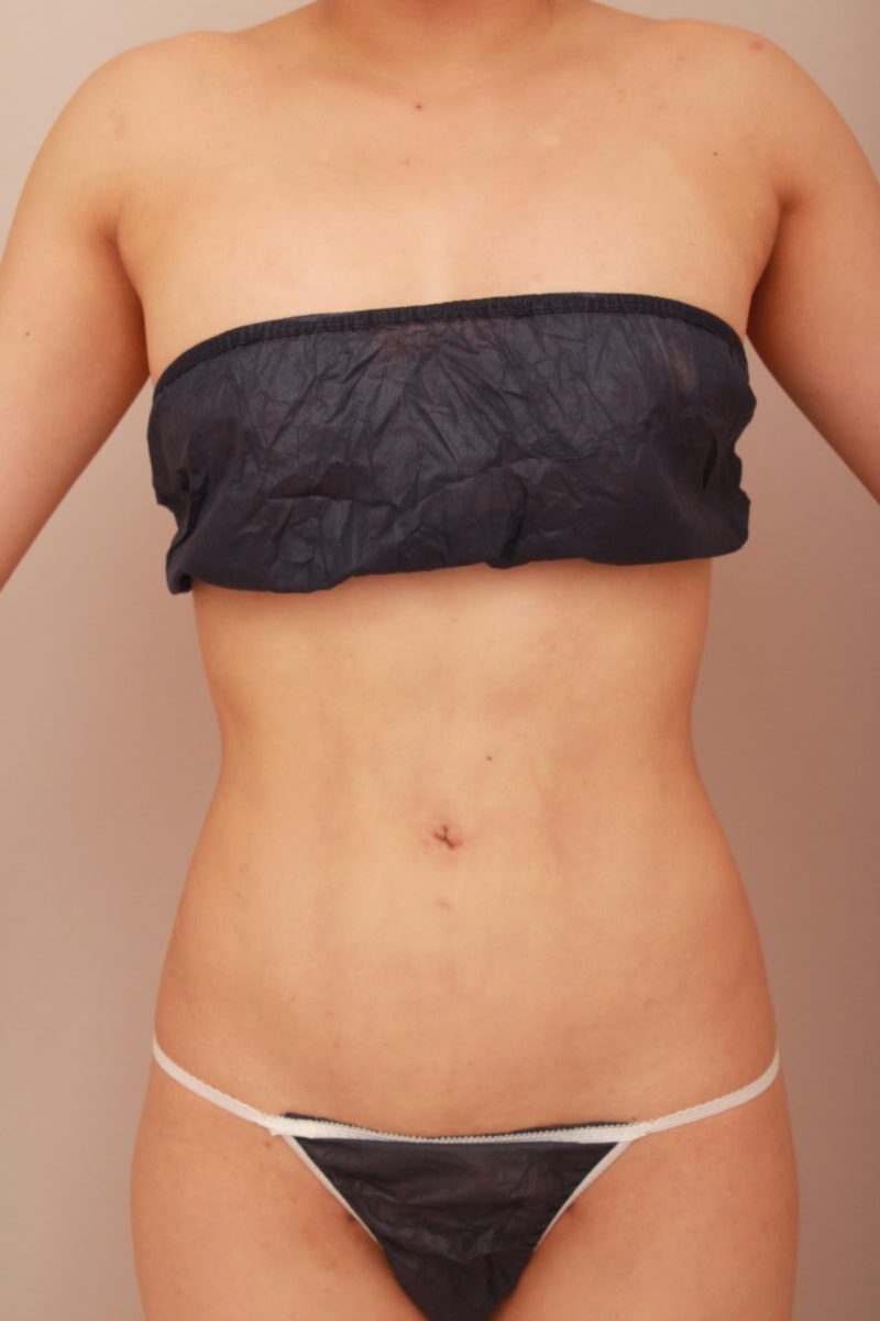 ダイエットでは限界のある部位には脂肪吸引が効果的です！