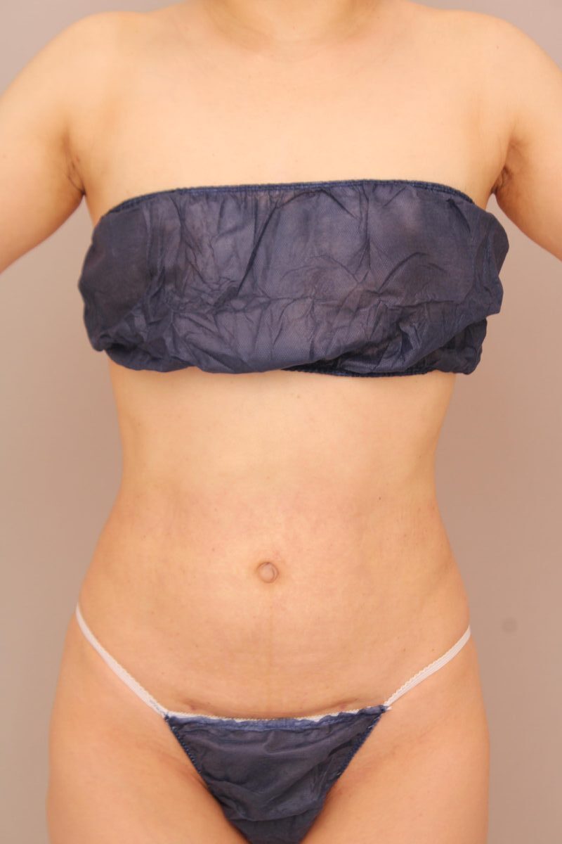 ダイエットでは落ちづらいおへそ周りや腰のシルエット作りは脂肪吸引が効果的です！