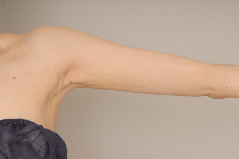 ベイザー脂肪吸引（１ヶ月経過：31）の術後写真