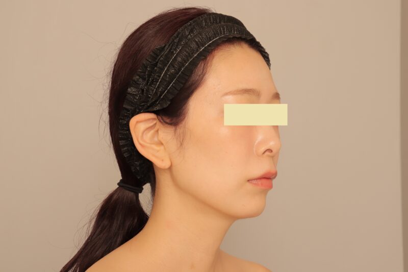 頬＋顎下の脂肪吸引術後３ヶ月