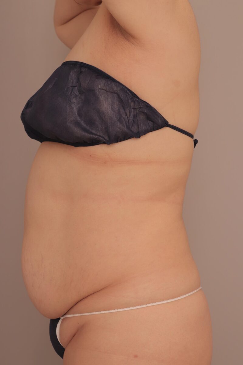 ベイザー脂肪吸引（3か月後経過：52）の術前写真