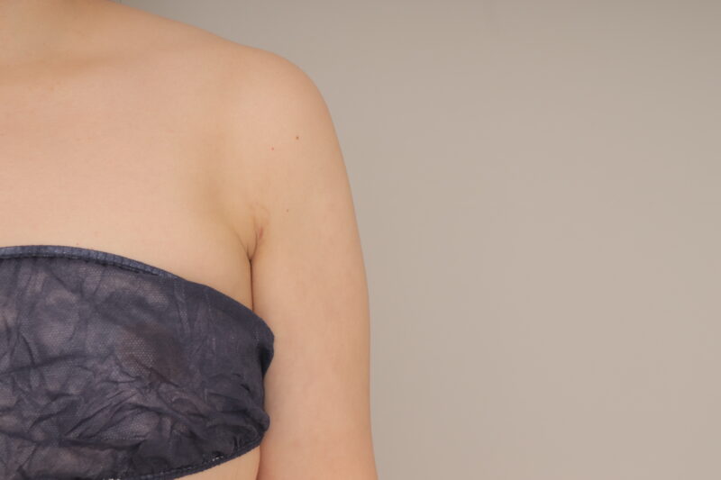 ベイザー脂肪吸引(1ヶ月経過:25)の術後写真