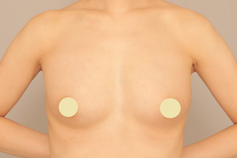 ★脂肪豊胸の経過！