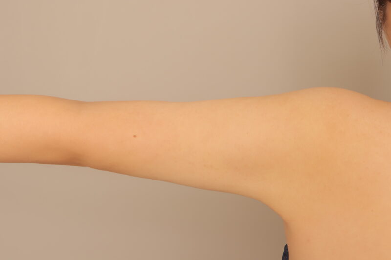 上腕全周の脂肪吸引で別人級の二の腕に♡