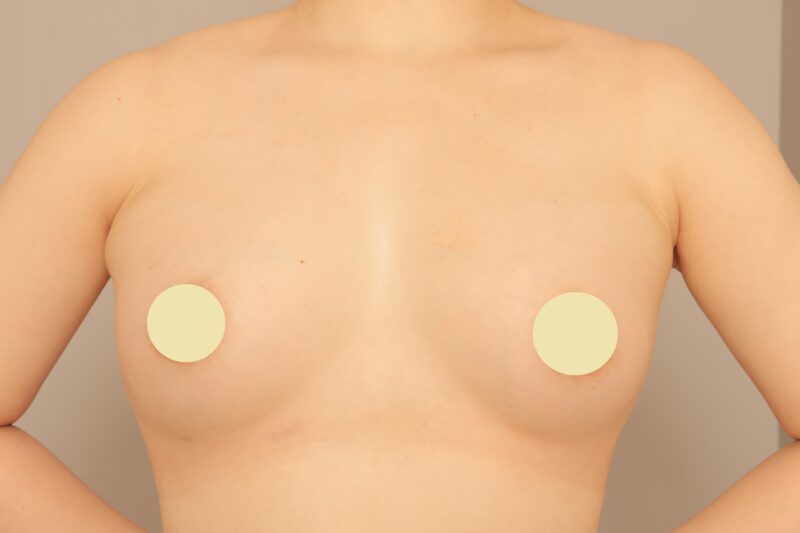 ★脂肪豊胸施術３ヶ月後
