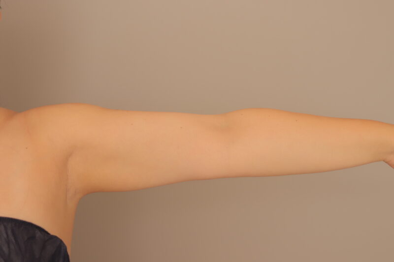 二の腕全周の脂肪吸引術後６ヶ月