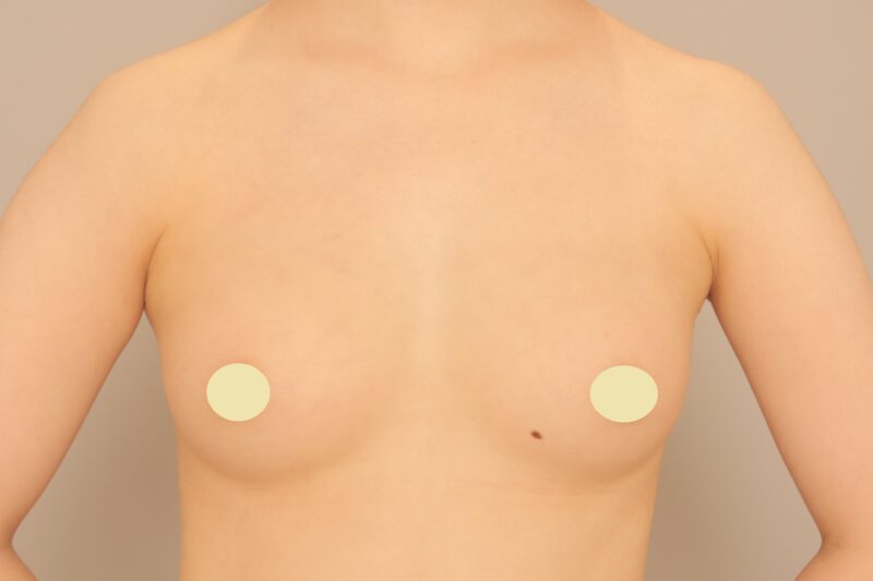 ベイザー脂肪吸引（１ヶ月経過：21）の術後写真