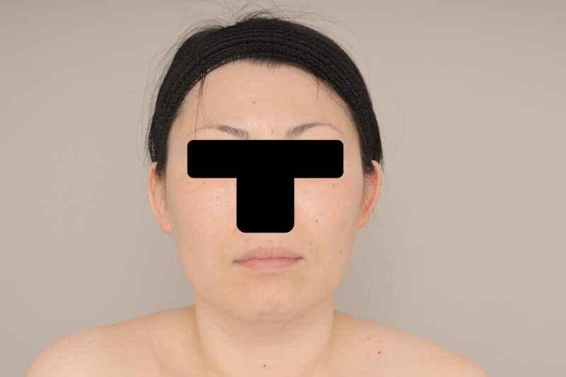 ベイザー脂肪吸引（２週間経過：38）の術前写真