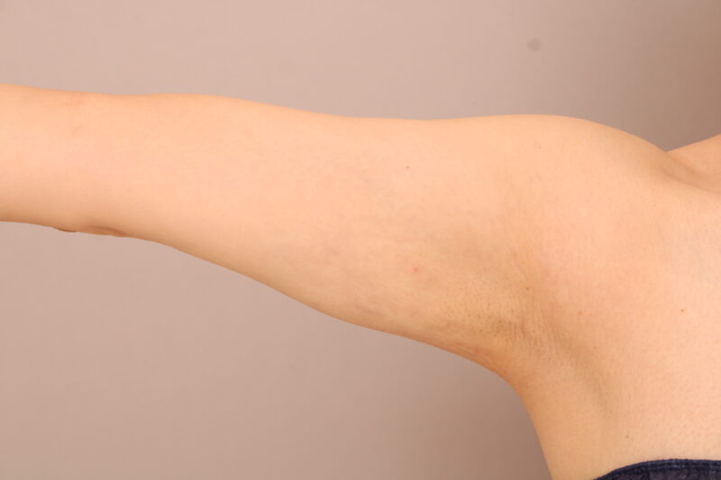 二の腕の細さと肩の張り出しの改善でストンと腕が長い印象に！