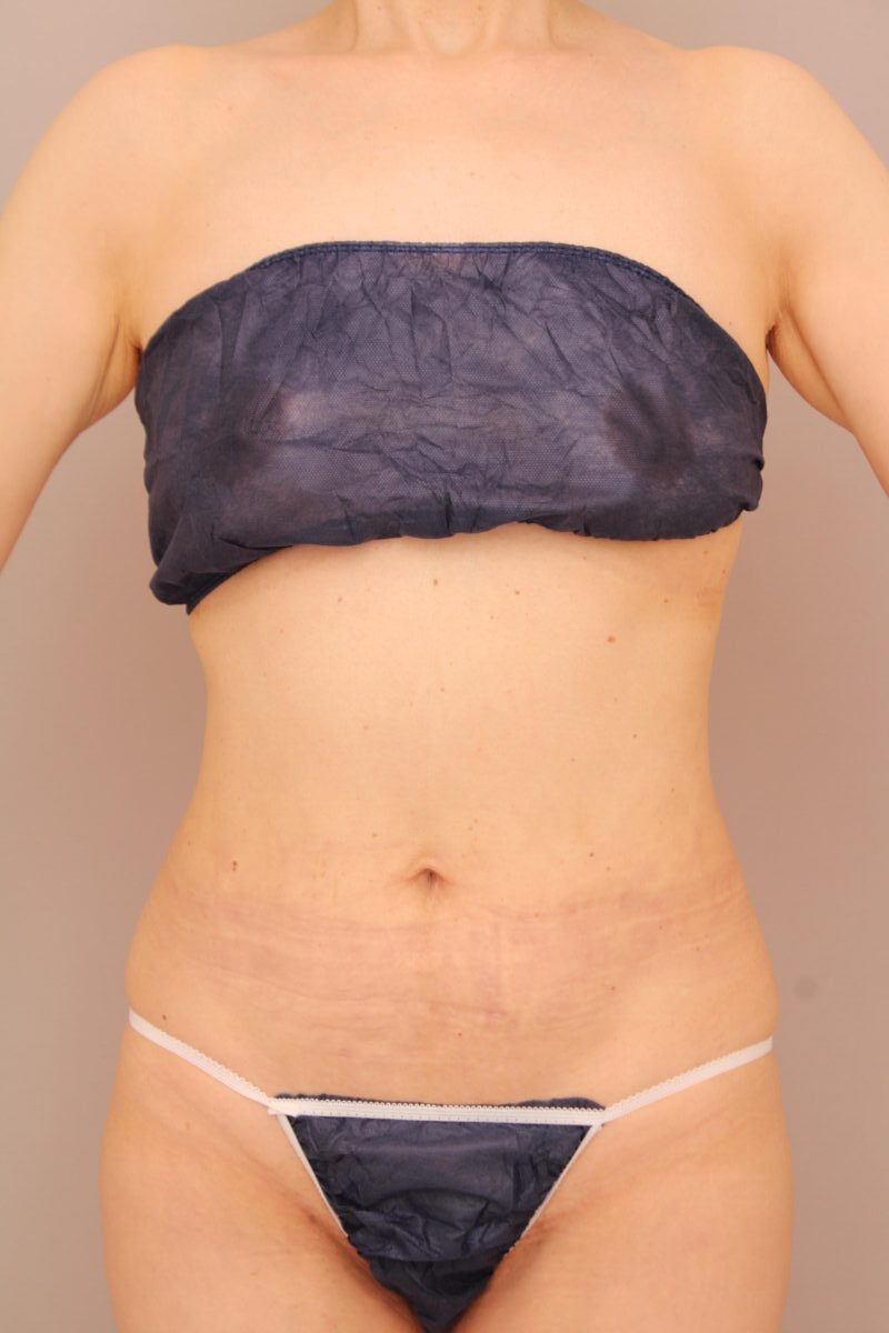 ダイエットで落ちづらい部位も脂肪吸引で理想のシルエットに！