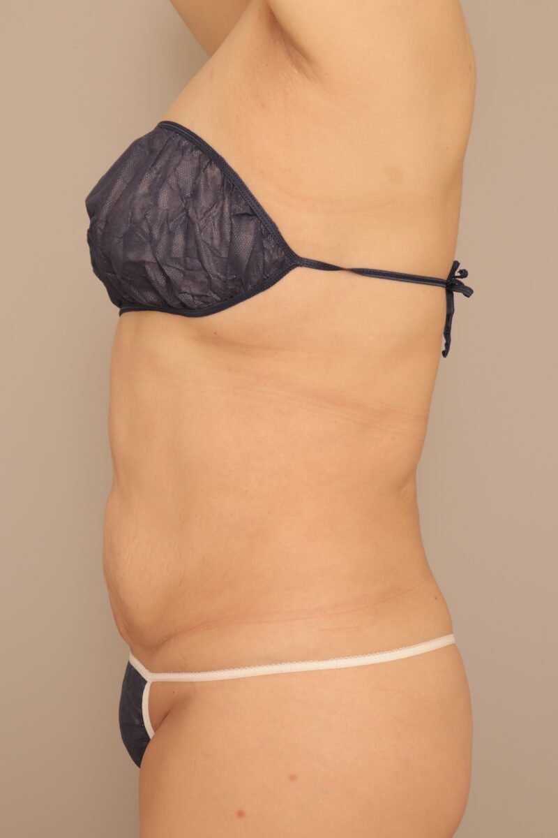 52歳154cm72kgBMI30以上のモニター様お腹全体胸下腰肩甲骨上下の脂肪吸引3ヶ月後