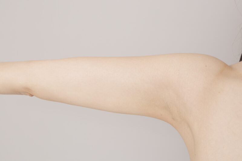 細身でもここまで変わる！二の腕＋肩＋脇肉700cc吸引で“まっすぐストン”とした華奢な腕へ