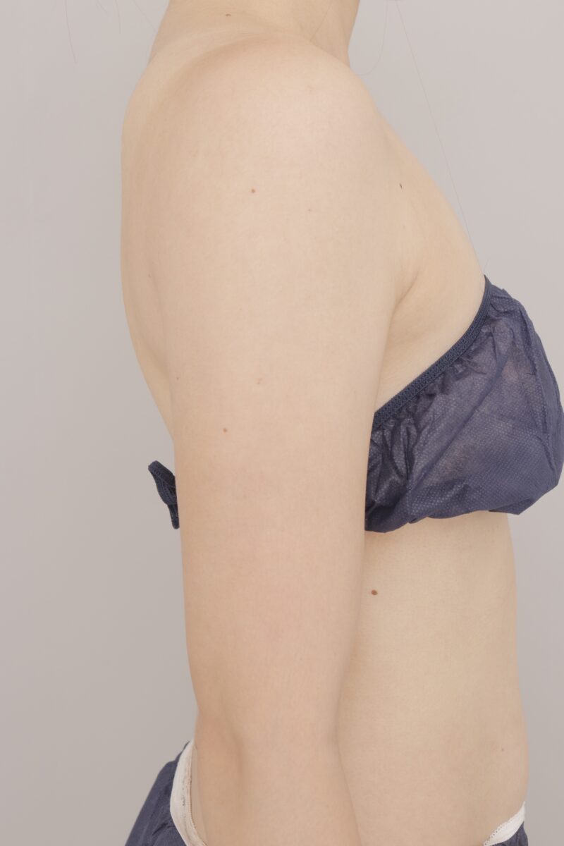 ベイザー脂肪吸引(3ヶ月経過:29)の術後写真