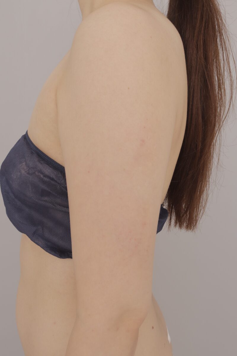 ベイザー脂肪吸引(3ヶ月経過:31)の術前写真