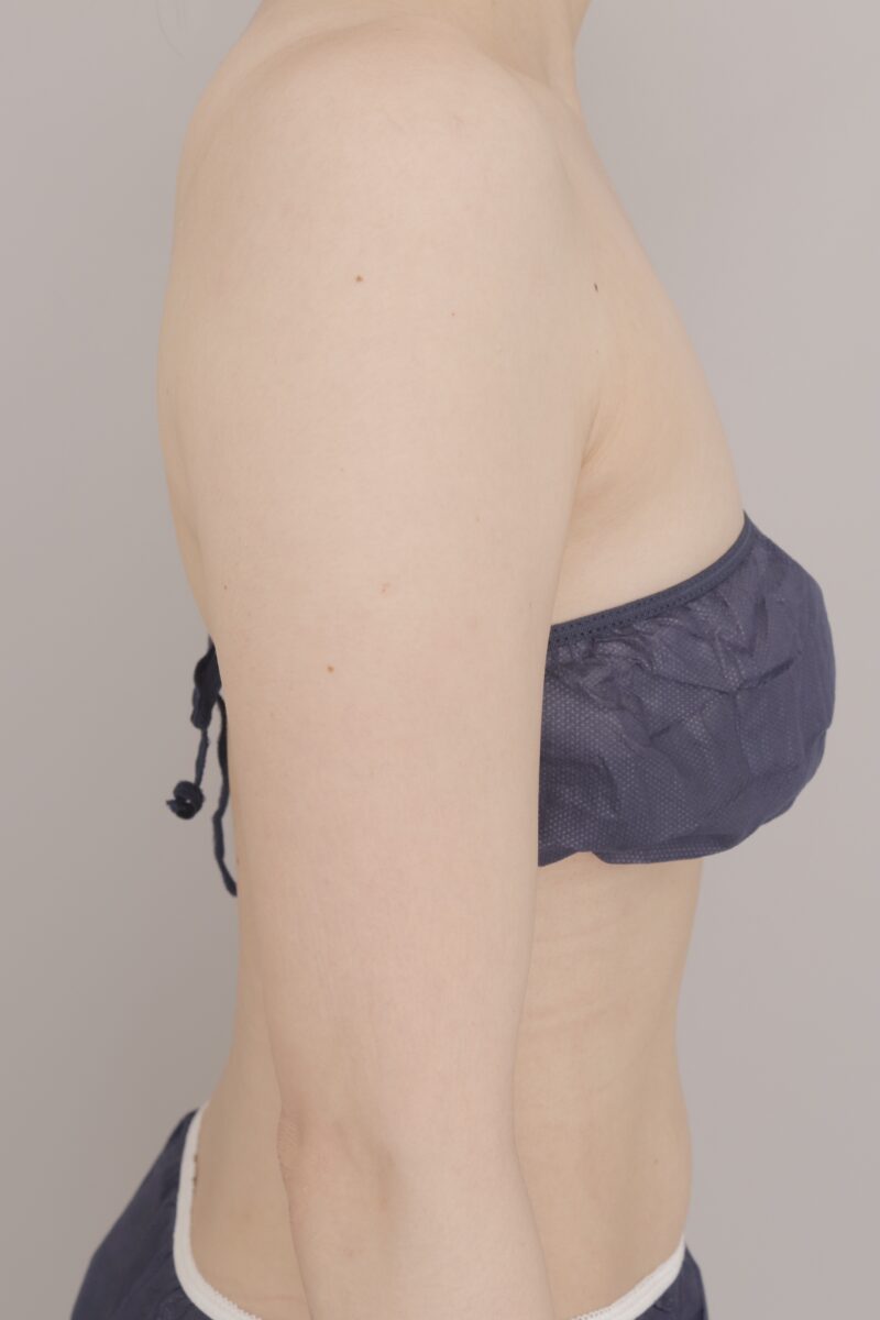 ベイザー脂肪吸引(3ヶ月経過:29)の術前写真