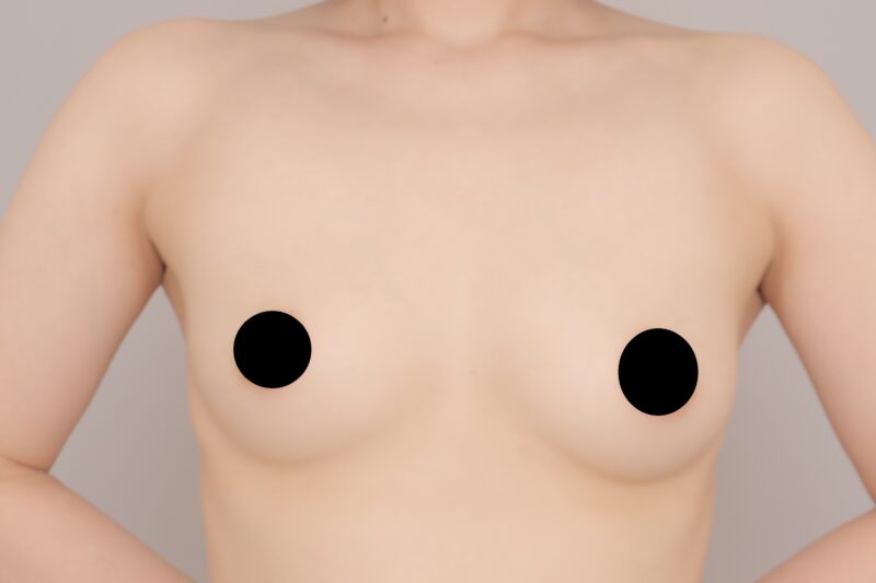 ベイザー脂肪吸引(1ヶ月経過:29)の術前写真