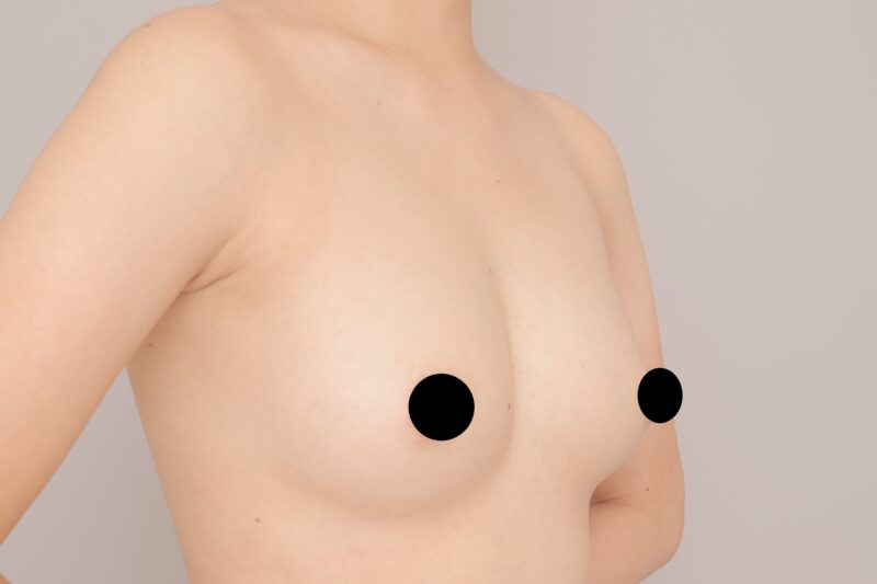 コンデンスリッチ豊胸半年後♪ モニター様の6か月経過をご紹介♪ 25歳 167cm 50kg