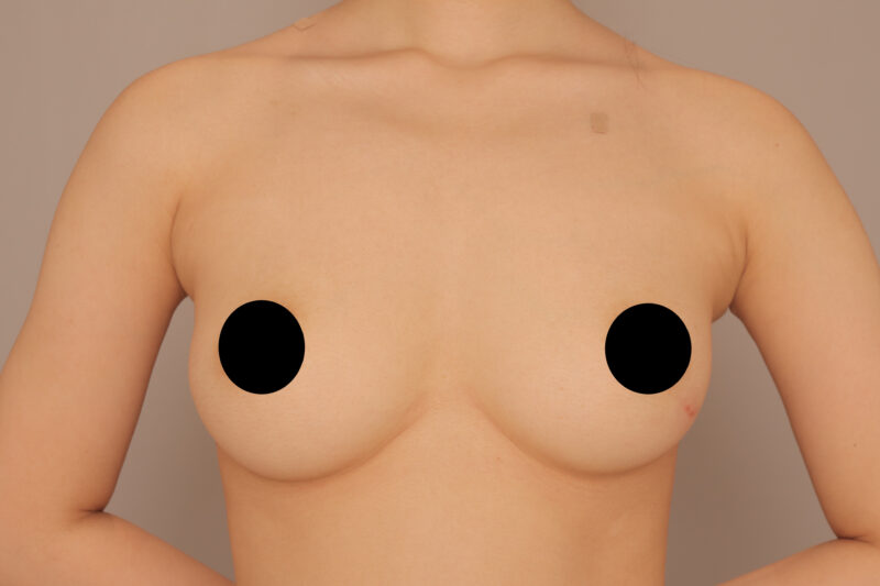 ベイザー脂肪吸引（半年後経過：25）の術前写真