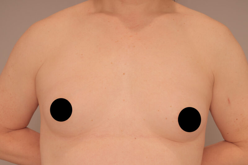 ベイザー脂肪吸引（半年後経過：58）の術前写真