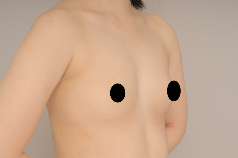 ベイザー脂肪吸引（3か月後経過：25）の術前写真