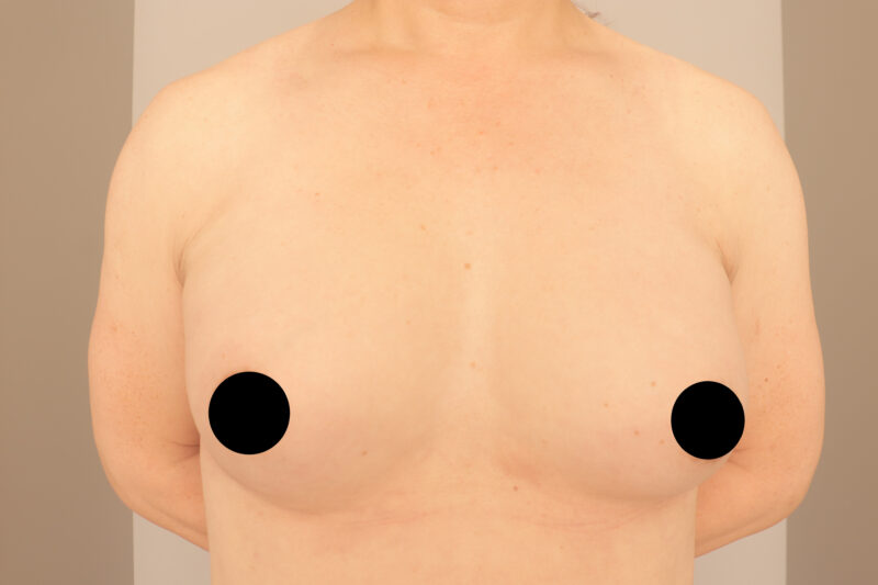 ベイザー脂肪吸引（半年後経過：58）の術後写真