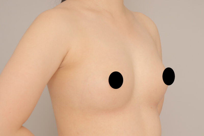 もう貧乳とは言わせない！20代コンデンスリッチ豊胸モニター様3ヶ月後♫