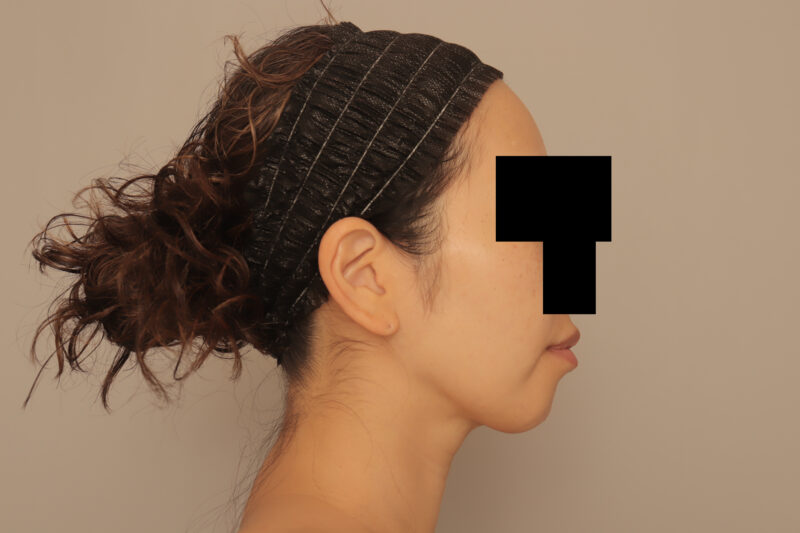 ベイザー脂肪吸引（半年後経過：36）の術後写真