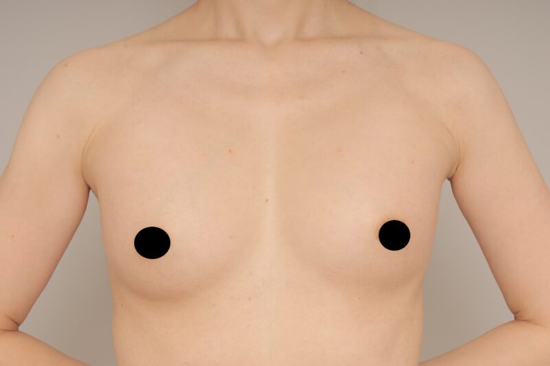 ベイザー脂肪吸引（1ヵ月経過：46）の術後写真